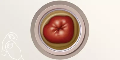 a close-up of an ostomy
